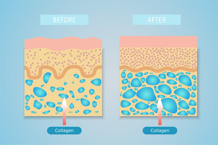 Collagen in skin before and after